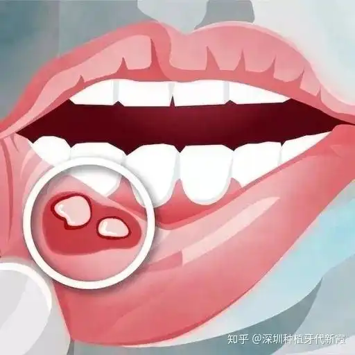 干嘛溃疡会使得口腔唾液分泌增多啊